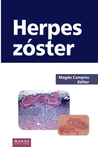 Herpes zóster