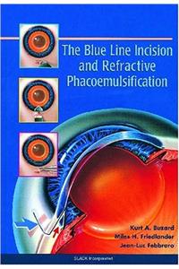Blue Line Incision and Refractive Phacoemulsification