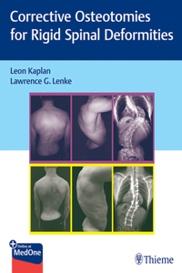 Corrective Osteotomies for Rigid Spinal Deformities