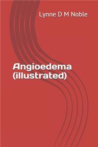 Angioedema (illustrated)