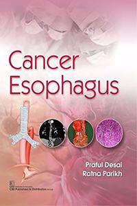 Cancer Esophagus