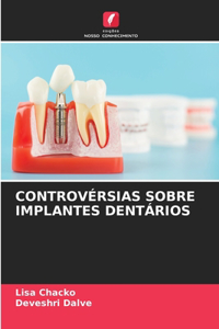 Controvérsias Sobre Implantes Dentários