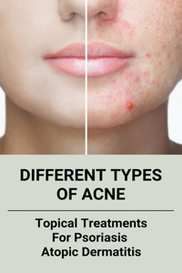 Different Types Of Acne