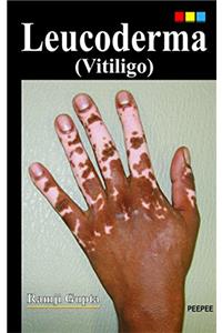 Leucoderma (Vitiligo)