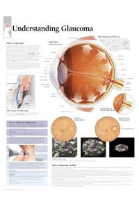 Understanding Glaucoma Laminated Poster