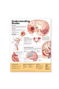 Understanding Stroke Anatomical Chart