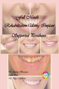 Full Mouth Rehabilitation Using Implant Supported Prostheses