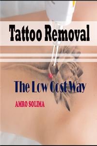 Tattoo Removal