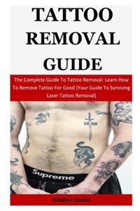 Tattoo Removal Guide