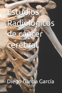 Estudios Radiológicos de cáncer cerebral