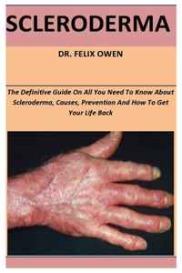 Scleroderma: The Definitive Guide On All You Need To Know About Scleroderma, Causes, Prevention And How To Get Your Life Back