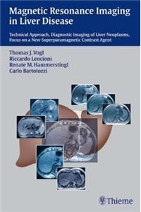 Magnetic Resonance Imaging in Liver Disease: Technical Approach, Diagnostic Imaging of Liver Neoplasms, Focus on a New Superparamagnetic Contrast Agent