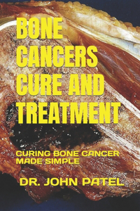 Bone Cancers Cure and Treatment