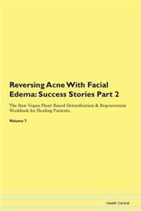 Reversing Acne With Facial Edema