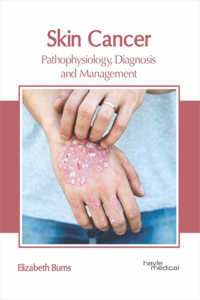 Skin Cancer: Pathophysiology, Diagnosis and Management
