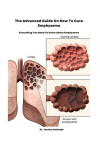 Advanced Guide On How To Cure Emphysema