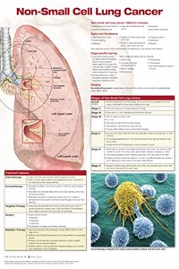 Non-Small Cell Lung Cancer, Chart Laminated