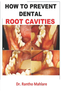 How to Prevent Dental Root Cavities