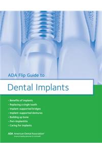 ADA Flip Guide to Dental Implants