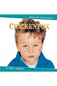 Chickenpox