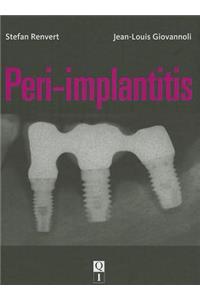 Peri-implantitis