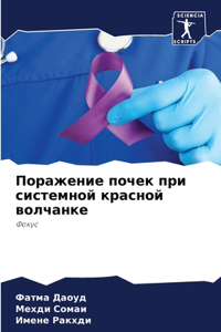 Поражение почек при системной красной вол