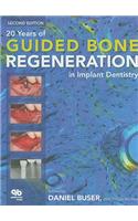 20 Years of Guided Bone Regeneration in Implant Dentistry