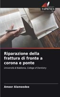 Riparazione della frattura di fronte a corona e ponte