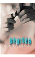 Bruises