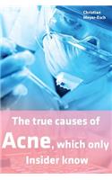 true causes of Acne, which only Insider know