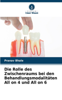 Die Rolle des Zwischenraums bei den Behandlungsmodalitäten All on 4 und All on 6