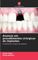Avanços em procedimentos cirúrgicos de implantes
