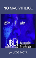 No más Vitiligo