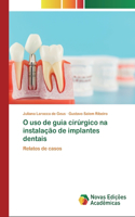O uso de guia cirúrgico na instalação de implantes dentais