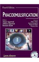 Phacoemulsification Surgery