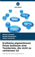 Erythema pigmentosum fixum bullosum eine Toxidermie, die nicht zu verkennen ist