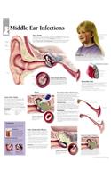 Middle Ear Infection Chart: Wall Chart