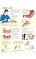 Peptic Ulcer Chart