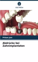 Abdrücke bei Zahnimplantaten