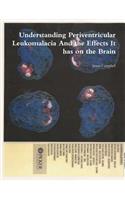 Understanding Periventricular Leukomalacia And the Effects It has on the Brain