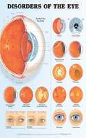 Disorders of the Eye Anatomical Chart: (English)