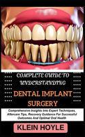 Complete Guide to Understanding Dental Implant Surgery