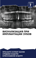 ВИЗУАЛИЗАЦИЯ ПРИ ИМПЛАНТАЦИИ ЗУБОВ