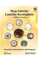 Deep Anterior Lamellar Keratoplasty Different Strokes