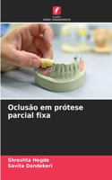 Oclusão em prótese parcial fixa