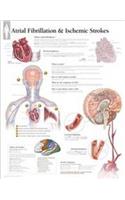 Atrial Fib & Ischemic Strokes Laminated Poster