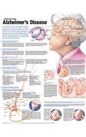 Understanding Alzheimer's Disease Anatomical Chart