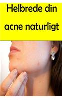 Helbrede din acne naturligt