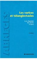 Les Varices Et Télangiectasies