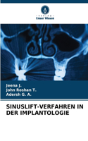 Sinuslift-Verfahren in Der Implantologie